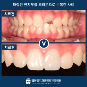 월영동레진치료7