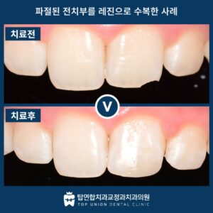 월영동앞니치료6